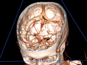 3D-brain-stent
